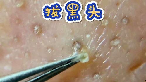 挤痘痘和挤黑头的视频,视频教学与注意事项